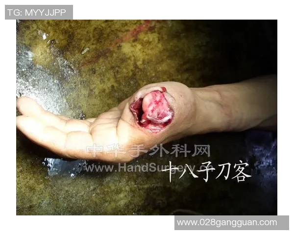 灰熊队韦尔斯右脚大拇指肌腱撕脱性骨折将进行手术治疗